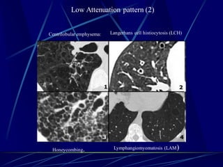 Low Attenuation pattern (2)
Centrilobular emphysema: Langerhans cell histiocytosis (LCH)
Honeycombing. Lymphangiomyomatosis (LAM)
 