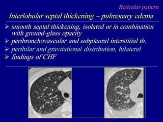 Reticular pattern
Interlobular septal thickening – pulmonary edema
 smooth septal thickening, isolated or in combination
with ground-glass opacity
 peribronchovascular and subpleural interstitial th.
 perihilar and gravitational distribution, bilateral
 findings of CHF
 