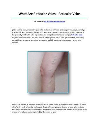 What Are Reticular Veins - Reticular Veins
_____________________________________________________________________________________
By Jan Kin - http://reticularveins.net/
Spider and varicose veins receive quite a bit of attention in the cosmetic surgery industry but one type
of vein is just as common but receives a lot less attention.Reticular veins are flat, blue or green veins
that generally reside within the legs and despite being a few millimeters in length, Reticular Veins
they are visible from below the skin's surface. Although they can cause slight discomfort, they rarely
come with any symptoms or medical complications which puts them in the category of cosmetic
concerns.
They can be isolated as single veins or they can be "feeder veins," the hidden cause of superficial spider
veins. While swelling, bruising and leg pain frequently accompany spider and varicose veins, reticular
veins tend to evoke hardly any side effects. However, they are slightly more noticeable than other types
because of length, color and depth making them easy to spot.
 