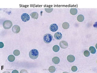 Stage III(later stage intermediate)
F 13-10-2018 11SUNIL KUMAR. P
 
