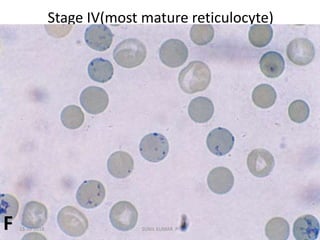 Stage IV(most mature reticulocyte)
F 13-10-2018 12SUNIL KUMAR. P
 