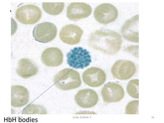 • H
HbH bodies
13-10-2018 26SUNIL KUMAR. P
 