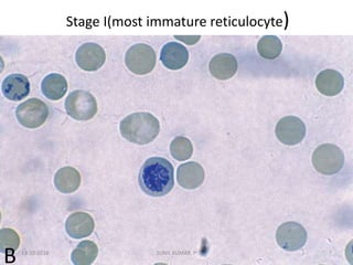 Stage I(most immature reticulocyte)
B 13-10-2018 7SUNIL KUMAR. P
 