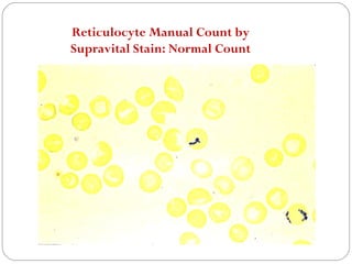 Reticulocyte Manual Count by
Supravital Stain: Normal Count
 