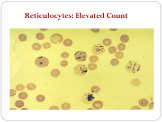 Reticulocytes: Elevated Count
 