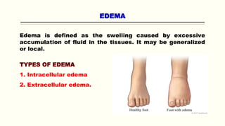 EDEMA
Edema is defined as the swelling caused by excessive
accumulation of fluid in the tissues. It may be generalized
or local.
TYPES OF EDEMA
1. Intracellular edema
2. Extracellular edema.
 