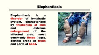 Elephantiasis
Elephantiasis is a
disorder of lymphatic
system, characterized
by thickening of skin
and extreme
enlargement of the
affected area, most
commonly limbs (legs),
certain areas of trunk
and parts of head.
 