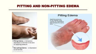 PITTING AND NON-PITTING EDEMA
 