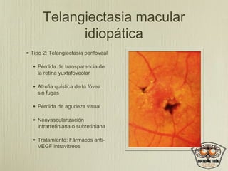 Telangiectasia macular
idiopática
•

Tipo 2: Telangiectasia perifoveal

•

Pérdida de transparencia de
la retina yuxtafoveolar

•

Atrofia quística de la fóvea
sin fugas

•

Pérdida de agudeza visual

•

Neovascularización
intrarretiniana o subretiniana

•

Tratamiento: Fármacos antiVEGF intravítreos

 