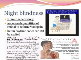 Night blindness
 vitamin A deficiency
 not enough quantities of
retinal to reform rhodopsin
 but in daytime cones can still
be excited
 