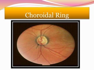 Choroidal Ring
 