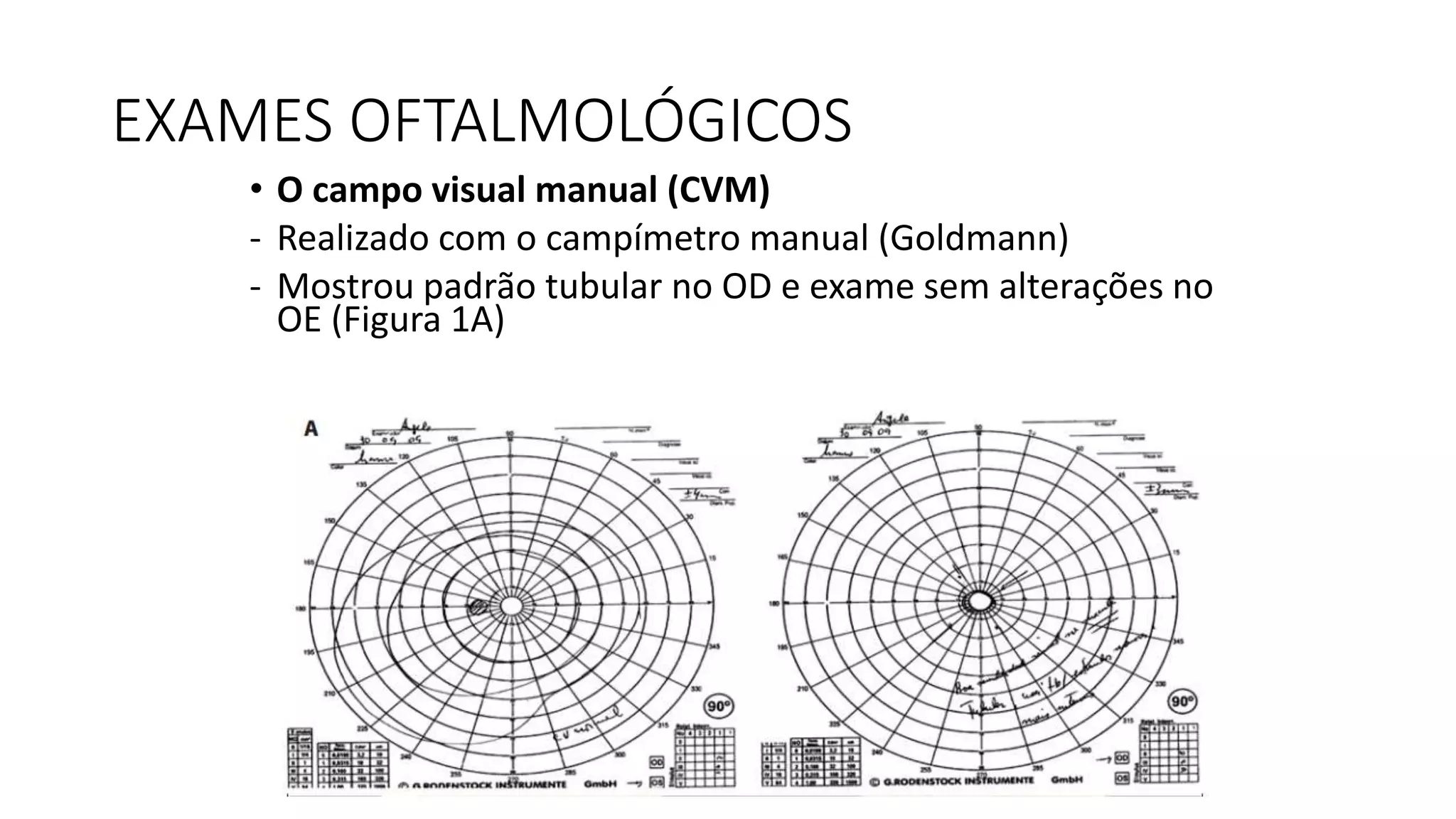 EXAMES OFTALMOLÓGICOS
• O campo visual manual (CVM)
- Realizado com o campímetro manual (Goldmann)
- Mostrou padrão tubular no OD e exame sem alterações no
OE (Figura 1A)
 