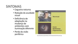 SINTOMAS
• Cegueira noturna
• Redução da acuidade
visual
• Deficiência de
adaptação na
mudança de
ambientes com
iluminação diferente
• Perda da visão
periférica http://retinabrasil.org.br/site/wp-content/uploads/2013/01/doenca01.jpg
 