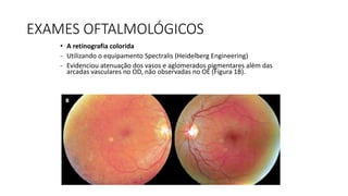 EXAMES OFTALMOLÓGICOS
• A retinografia colorida
- Utilizando o equipamento Spectralis (Heidelberg Engineering)
- Evidenciou atenuação dos vasos e aglomerados pigmentares além das
arcadas vasculares no OD, não observadas no OE (Figura 1B).
 