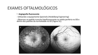 EXAMES OFTALMOLÓGICOS
• Angiografia fluorescente
- Utilizando o equipamento Spectralis (Heidelberg Engineering)
- Observou-se padrão numular hipofluorescente na média periferia no OD e
dentro dos padrões da normalidade no OE (Figura 1C).
 