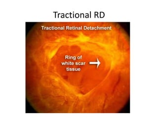 Mild Tractional Rd Retinal Examination& Invistegation | PPTX
