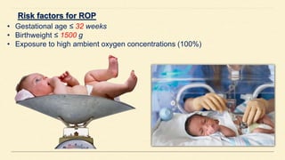 • Gestational age ≤ 32 weeks
• Birthweight ≤ 1500 g
• Exposure to high ambient oxygen concentrations (100%)
 
