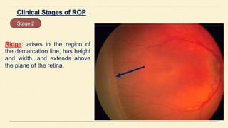 Ridge: arises in the region of
the demarcation line, has height
and width, and extends above
the plane of the retina.
Stage 2
 