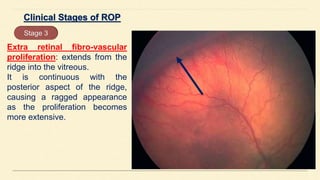 Extra retinal fibro-vascular
proliferation: extends from the
ridge into the vitreous.
It is continuous with the
posterior aspect of the ridge,
causing a ragged appearance
as the proliferation becomes
more extensive.
Stage 3
 