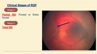 Partial RD: Foveal or Extra
foveal
Stage 4
Total RD
Stage 5
 