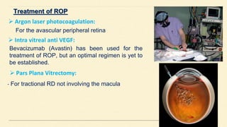  Argon laser photocoagulation:
For the avascular peripheral retina
 Intra vitreal anti VEGF:
 Pars Plana Vitrectomy:
- For tractional RD not involving the macula
Bevacizumab (Avastin) has been used for the
treatment of ROP, but an optimal regimen is yet to
be established.
 