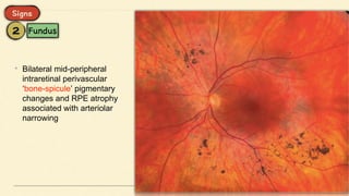 • Bilateral mid-peripheral
intraretinal perivascular
‘bone-spicule’ pigmentary
changes and RPE atrophy
associated with arteriolar
narrowing
 