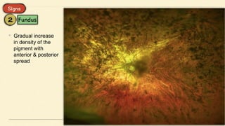 • Gradual increase
in density of the
pigment with
anterior & posterior
spread
 