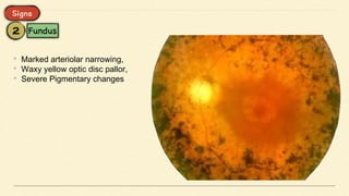 • Marked arteriolar narrowing,
• Waxy yellow optic disc pallor,
• Severe Pigmentary changes
 