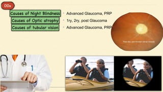 • Advanced Glaucoma, PRP
• 1ry, 2ry, post Glaucoma
• Advanced Glaucoma, PRP
 