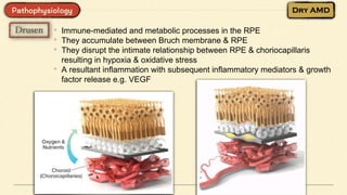 • Immune-mediated and metabolic processes in the RPE
• They accumulate between Bruch membrane & RPE
• They disrupt the intimate relationship between RPE & choriocapillaris
resulting in hypoxia & oxidative stress
• A resultant inflammation with subsequent inflammatory mediators & growth
factor release e.g. VEGF
 