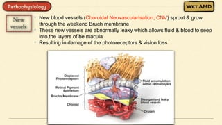 • New blood vessels (Choroidal Neovascularisation; CNV) sprout & grow
through the weekend Bruch membrane
• These new vessels are abnormally leaky which allows fluid & blood to seep
into the layers of he macula
• Resulting in damage of the photoreceptors & vision loss
 