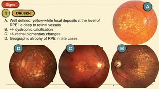 A. Well defined, yellow-white focal deposits at the level of
RPE i.e deep to retinal vessels
B. +/- dystrophic calcification
C. +/- retinal pigmentary changes
D. Geographic atrophy of RPE in late cases
 