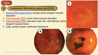 1. Serous PED detachment; orange dome shaped macular
elevation
2. Fibrovascular PED; much more macular elevation
3. Haemorrhagic PED; elevated, dark red, well defined, dome
shaped macular lesion
4. CNV; greyish green subfoveal membrane
 