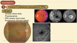 • Drusen show Auto
Fluorescence
• RPE atrophy show hyper
fluorescence (Window defect)
 