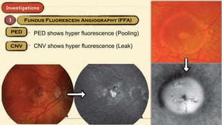• PED shows hyper fluorescence (Pooling)
• CNV shows hyper fluorescence (Leak)
 