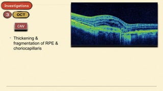 • Thickening &
fragmentation of RPE &
choriocapillaris
 