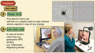 • Provided for home use
• self test on a regular basis to seek medical
advice urgently in case of any change
• In case of severe
vision loss e.g.
geographic RPE
atrophy
• e.g. Telescopes,
Magnifying lenses
 
