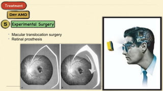 • Macular translocation surgery
• Retinal prosthesis
 