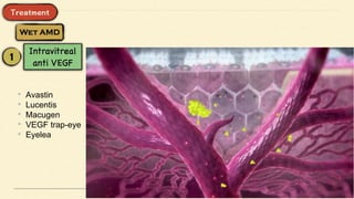 • Avastin
• Lucentis
• Macugen
• VEGF trap-eye
• Eyelea
 