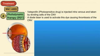 • Veteprofin (Photosensitive drug) is injected intra venous and taken
by dividing cells of the CNV
• A diode laser is used to activate this dye causing thrombosis of the
CNV
 