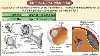Separation of the neurosensory retina (NSR) from the RPE. This results in the accumulation of
SRF in the potential space between the NSR and RPE.
 