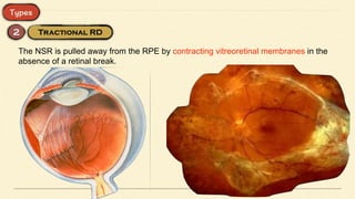 The NSR is pulled away from the RPE by contracting vitreoretinal membranes in the
absence of a retinal break.
 