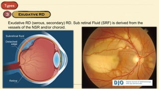 Exudative RD (serous, secondary) RD. Sub retinal Fluid (SRF) is derived from the
vessels of the NSR and/or choroid.
 