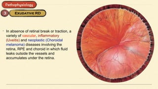 • In absence of retinal break or traction, a
variety of vascular, inflammatory
(Uveitis) and neoplastic (Choroidal
melanoma) diseases involving the
retina, RPE and choroid in which fluid
leaks outside the vessels and
accumulates under the retina.
 