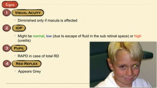 • Diminished only if macula is affected
• Might be normal, low (due to escape of fluid in the sub retinal space) or high
(uveitis)
• RAPD in case of total RD
• Appears Grey
 