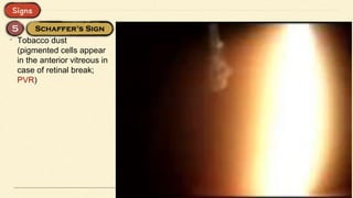 • Tobacco dust
(pigmented cells appear
in the anterior vitreous in
case of retinal break;
PVR)
 