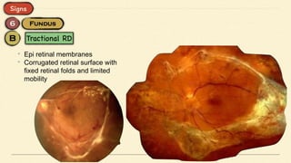 • Epi retinal membranes
• Corrugated retinal surface with
fixed retinal folds and limited
mobility
 
