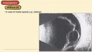 • In case of media opacity e.g. cataract
 