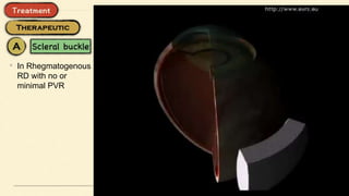 • In Rhegmatogenous
RD with no or
minimal PVR
 