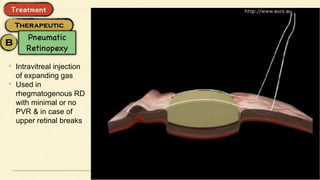 • Intravitreal injection
of expanding gas
• Used in
rhegmatogenous RD
with minimal or no
PVR & in case of
upper retinal breaks
 